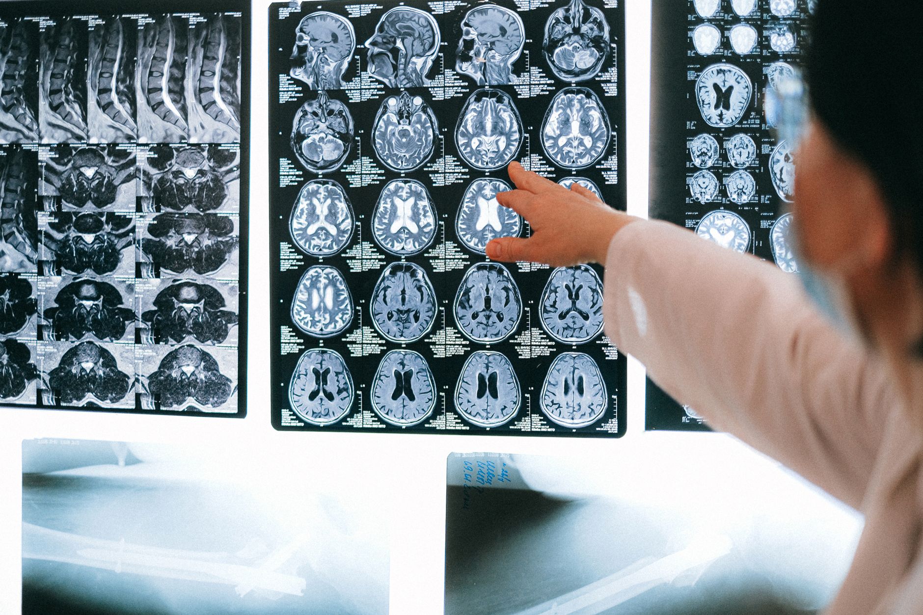 Radiologist pointing at brain MRI scans showing detailed medical examination.